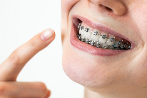 How Often Do Braces Need To Be Tightened?