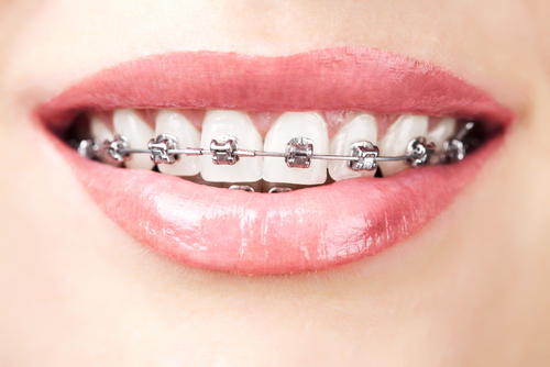 A Braces Dentist Can Transform Your Smile