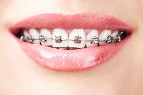 Braces Dentist