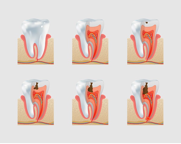 Why Should I Get Cavities Treated?