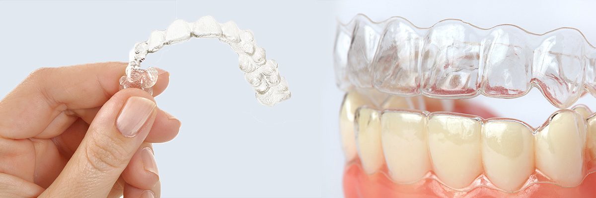 Clear Aligners