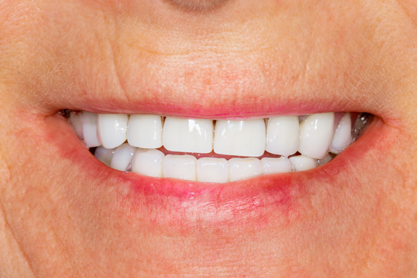 Getting A Broken  Dental Crown Repaired Or Replaced