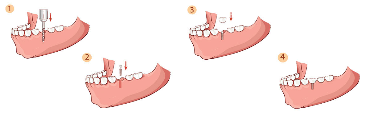 Long Branch Dental Implant Restoration