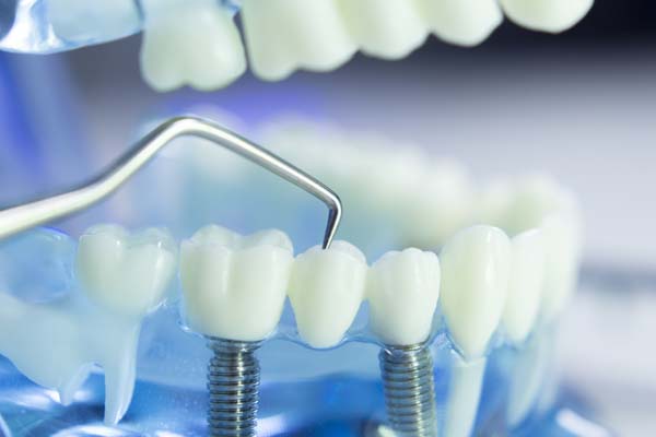 Recommended Aftercare For Dental Implants