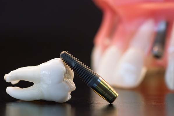Placing Crowns On Dental Implants