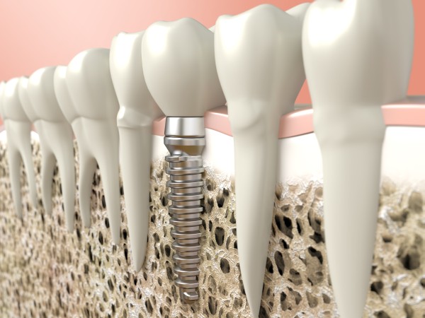 Are You Tired Of Wearing Dentures? Try Dental Implants