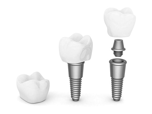 Dental Implants: The Future Of Tooth Replacement