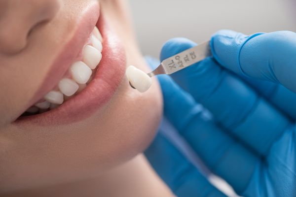 What You Need To Know Before Getting Dental Veneers