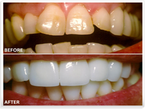 We Use Dental Veneers In Long Branch To Correct A Variety Of Challenges