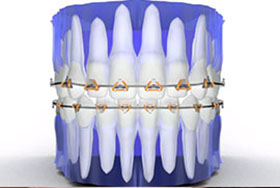 Fastbraces®