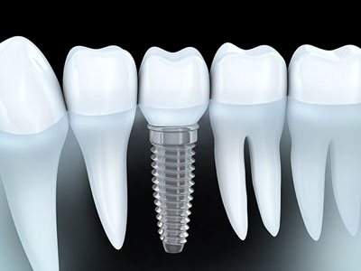Implant Overdentures Are An Excellent Hybrid Solution For Tooth Loss
