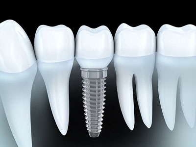 Implant Overdentures