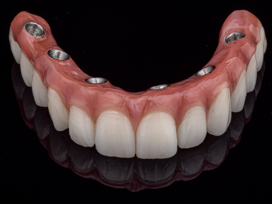 What Happens If I Need My Implant Supported Dentures Repaired?