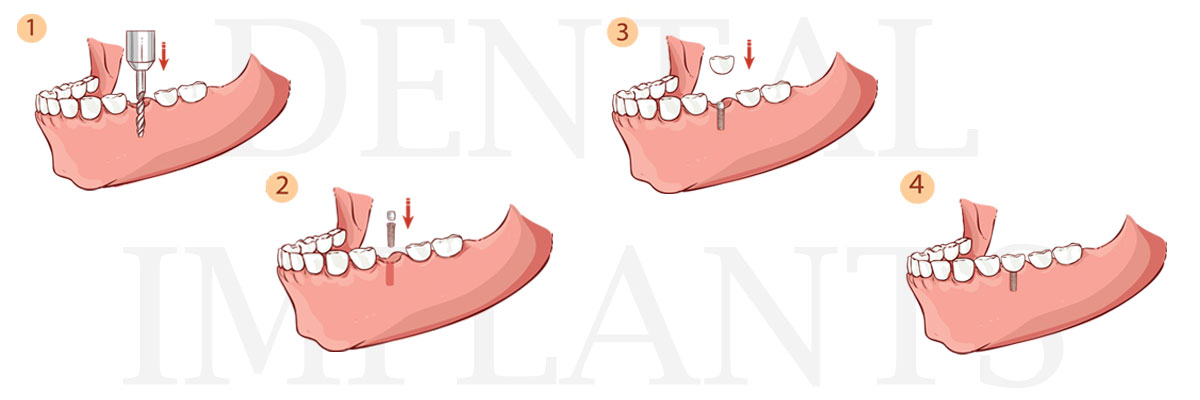 Long Branch The Difference Between Dental Implants and Mini Dental Implants