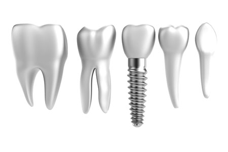 Mini Dental Implants