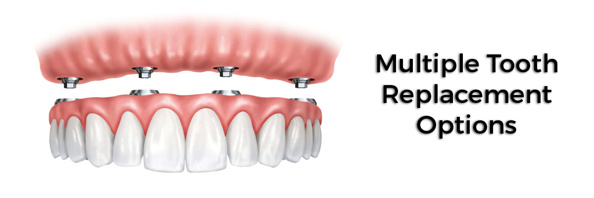 Long Branch Multiple Teeth Replacement Options