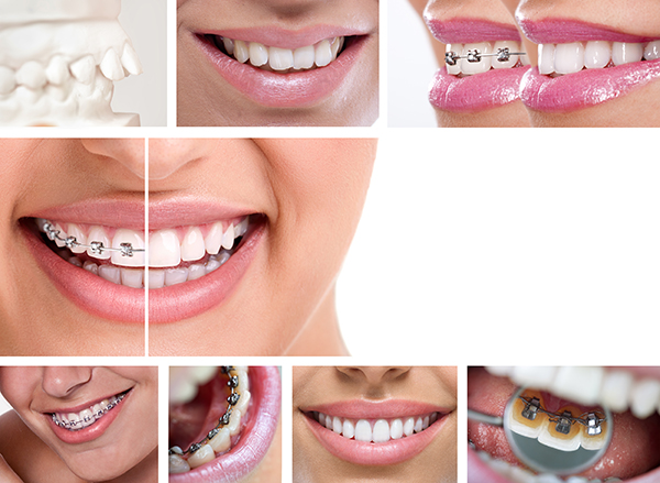 Three Things You Should Know About Orthodontics And Braces