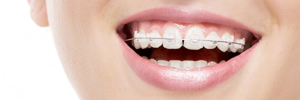 Long Branch Types of Braces