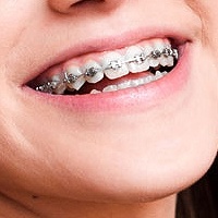 Types of Braces