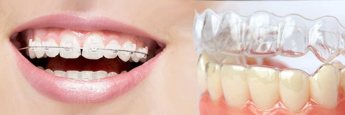 Long Branch Which is Better Invisalign or Braces