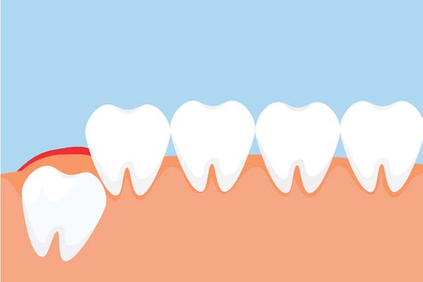 What Are Impacted Wisdom Teeth?