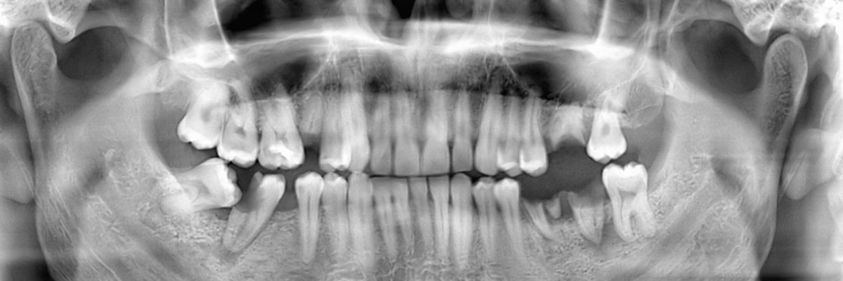 Long Branch Wisdom Teeth Extraction